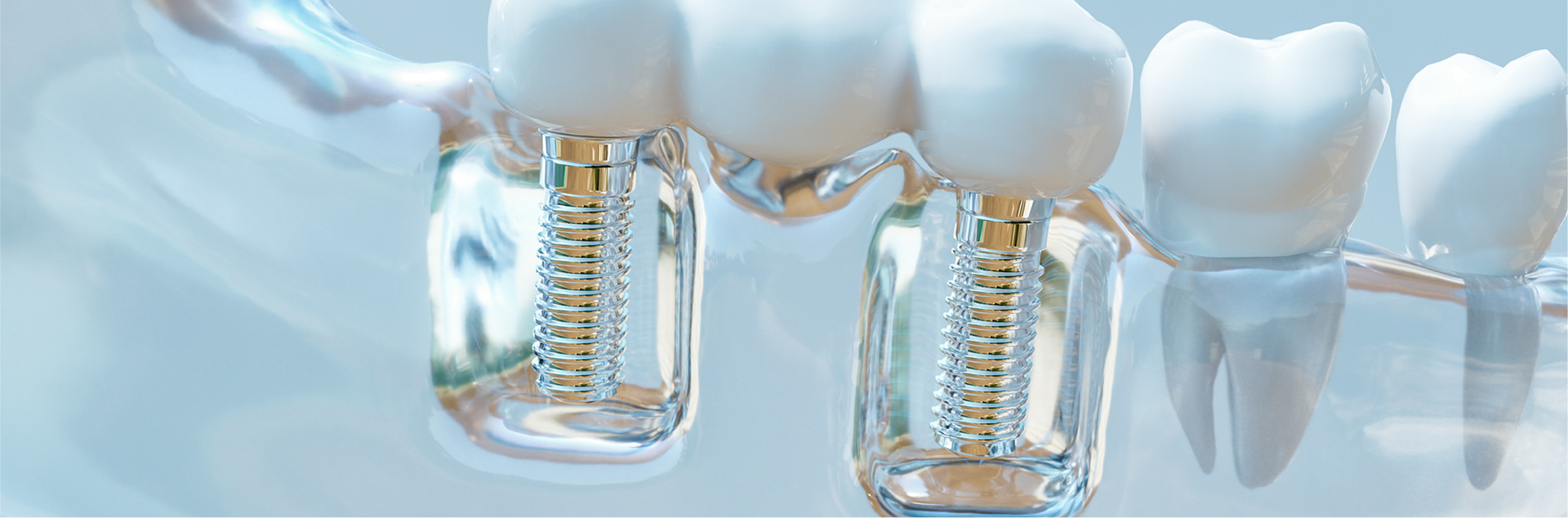 3D dental implants in a jaw model.